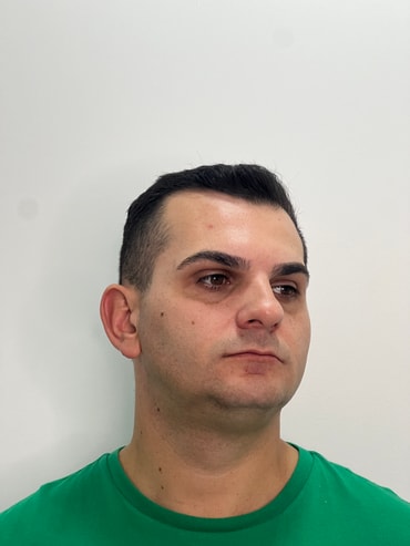 Zéfo antes da harmonização facial - sem barba